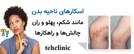 اسکارهای ناحیه بدن مانند شکم، پهلو و ران — چالش‌ها و راهکارها