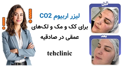 لیزر اربیوم CO2 برای ککومک و لکهای عمقی در صادقیه