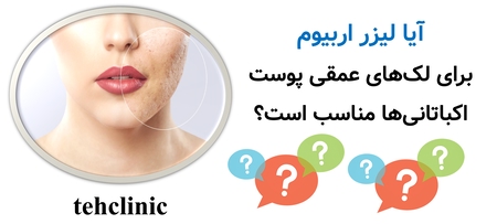 آیا لیزر اربیوم برای لک‌های عمقی پوست اکباتانی‌ها مناسب است؟