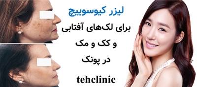 لیزر کیوسوییچ برای لک‌های آفتابی و کک‌ومک در پونک