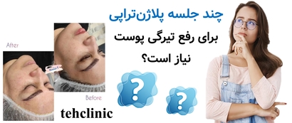 چند جلسه پلاژنتراپی برای رفع تیرگی پوست نیاز است؟