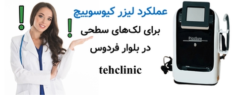 عملکرد لیزر کیوسوییچ برای لک‌های سطحی در بلوار فردوس