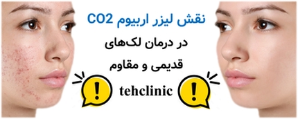 نقش لیزر اربیوم CO2 در درمان لک‌های قدیمی و مقاوم