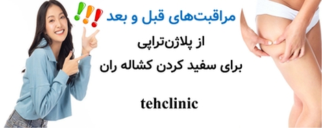 مراقبتهای قبل و بعد از پلاژنتراپی برای سفید کردن کشاله ران
