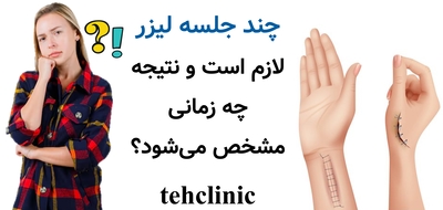 چند جلسه لیزر لازم است و نتیجه چه زمانی مشخص می‌شود؟