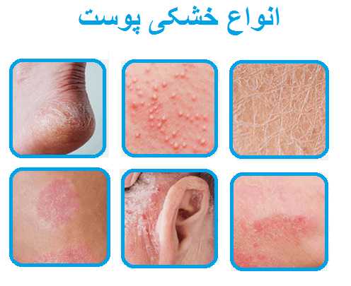 انواع خشکی پوست