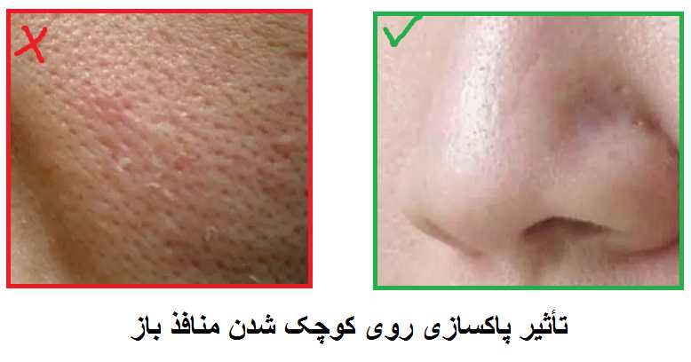 آیا منافذ پوستی در فیشیال باز می شوند ؟