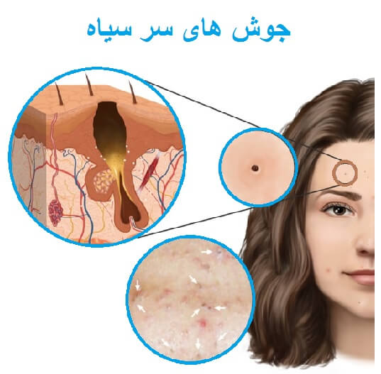 پاکسازی اصولی برای کاهش جوش‌های سرسیاه