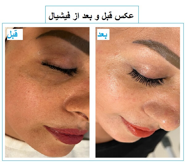 فیشیال مخصوص روشن‌سازی و رفع کدری