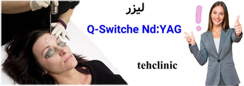 لیزر Q-Switched Nd:YAG