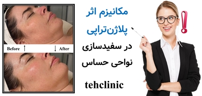 مکانیزم اثر پلاژن‌تراپی در سفیدسازی نواحی حساس