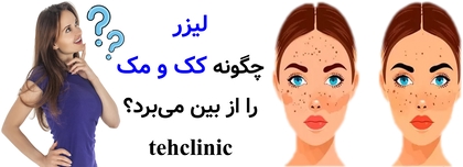 لیزر چگونه کک و مک را از بین می‌برد؟