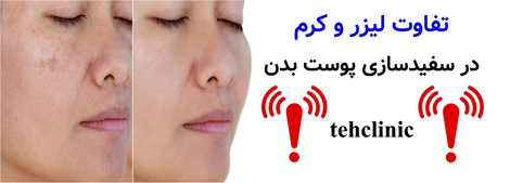 تفاوت لیزر و کرم در سفیدسازی پوست بدن