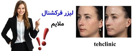 لیزر فرکشنال ملایم