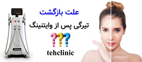 علت بازگشت تیرگی پس از وایتنینگ