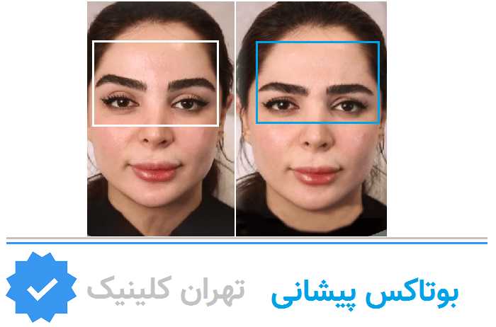 تزریق بوتاکس پیشانی