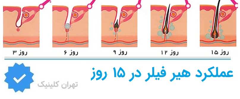 نتایج هیر فیلر