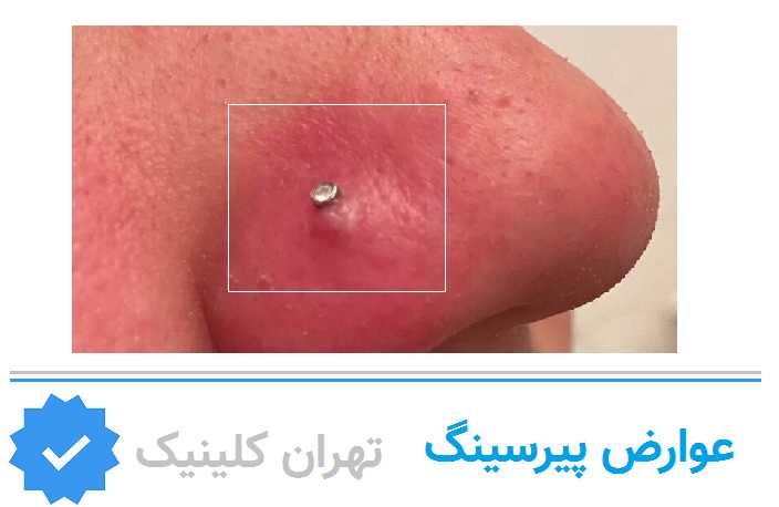 عوارض پیرسینگ