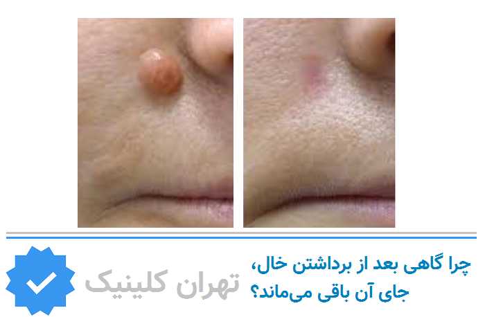 چرا گاهی بعد از برداشتن خال، جای آن باقی می‌ماند؟