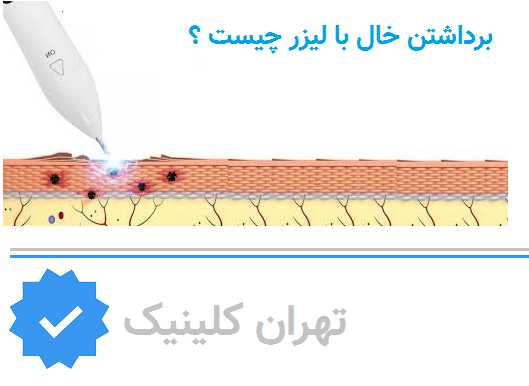 برداشتن خال چیست