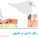 برداشتن خال با لیزر در هروی