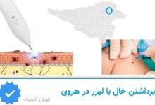 برداشتن خال با لیزر در هروی