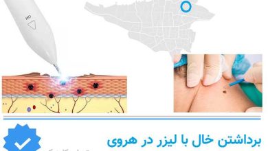 برداشتن خال با لیزر در هروی