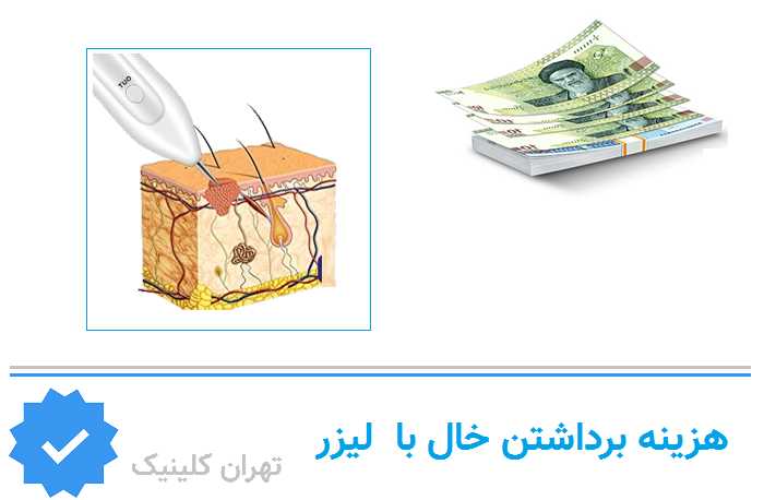 هزینه برداشتن خال در هروی چقدر است و به چه عواملی بستگی دارد؟