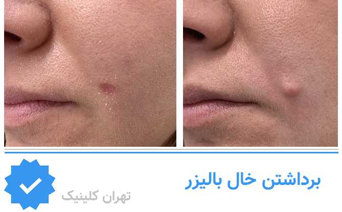  برداشتن خال با لیزر 