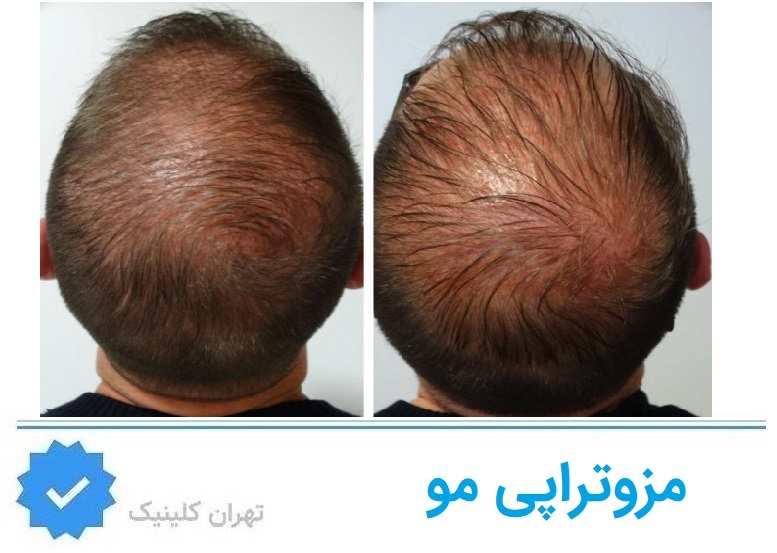 مزوتراپی مو