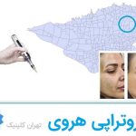 مزوتراپی هروی