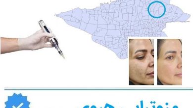 مزوتراپی هروی