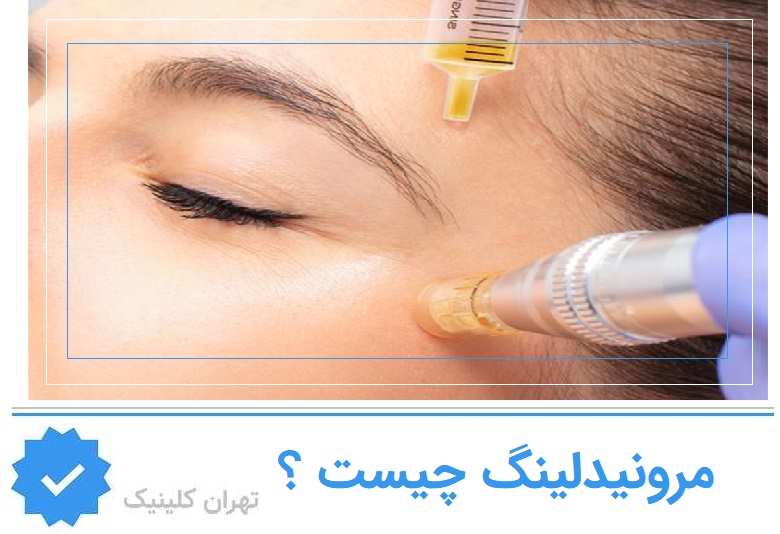 مزونیدلینگ دقیقاً چیست