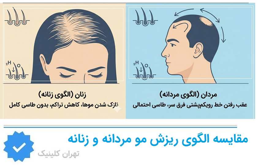 مقایسه الگو ریزش مو مردانه و زنانه