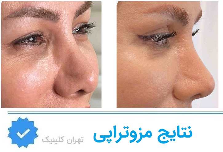 مزوتراپی چیست