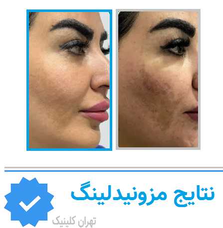 نتایج مزونیدلینگ