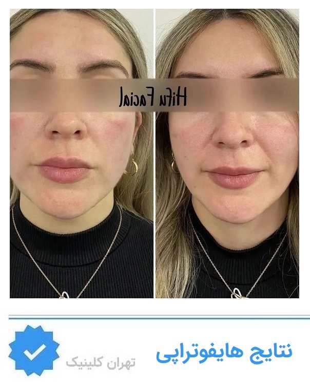 نتیجه هایفوتراپی