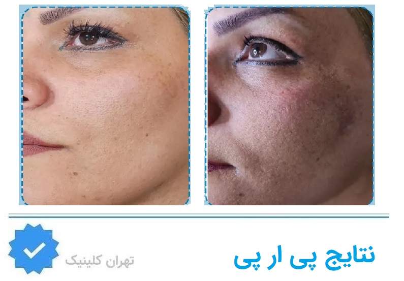 نتایج پی آر پی