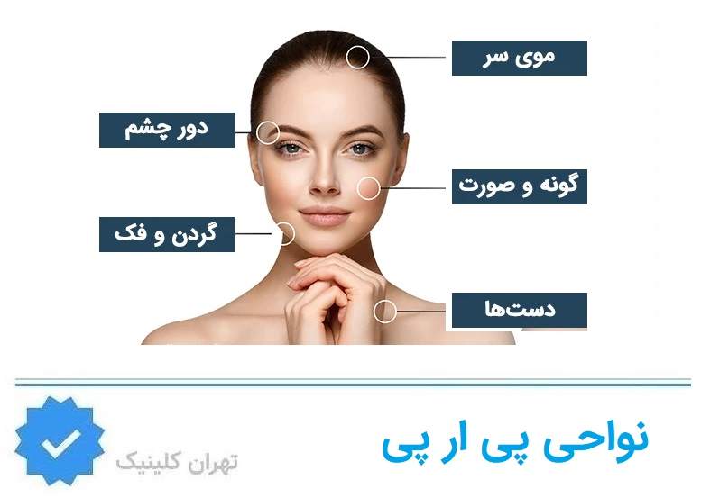 نواحی پی ار پی