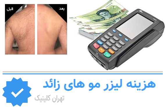 هزینه لیزر آقایان در شرق تهران