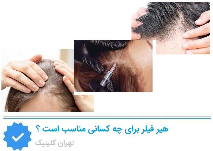 هیر فیلر برای چه افرادی در شرق تهران گزینه مناسبی است؟