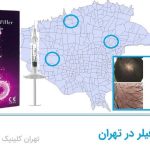 مراکز هیر فیلر تهران