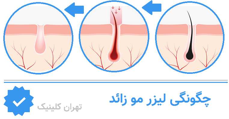 چگونگی لیزر مو زائد