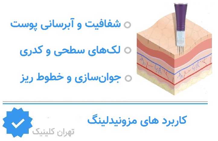 کاربرد های مزونیدلینگ