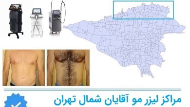 لیزر مو اقایان شمال تهران