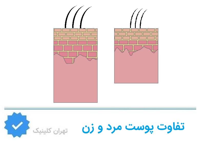 تفاوت لیزر مرد و زن