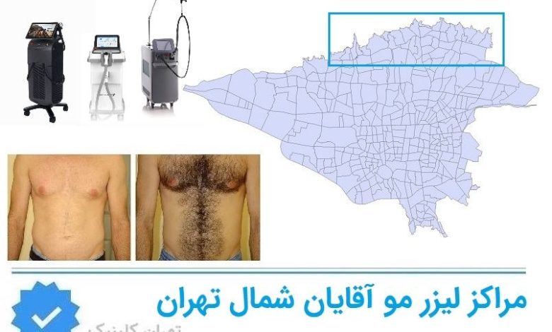 لیزر مو اقایان شمال تهران