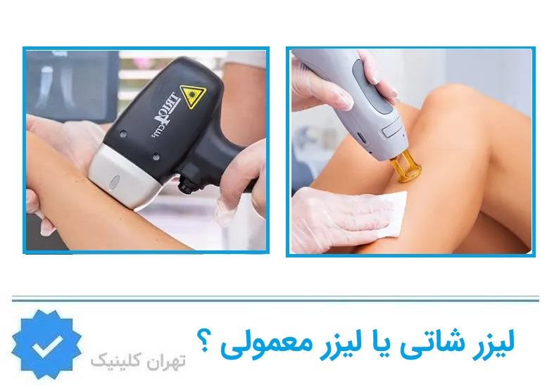 لیزر شاتی یا حرکتی برای آقایان