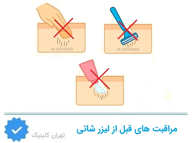 مرقبت های قبل از لیزر شاتی