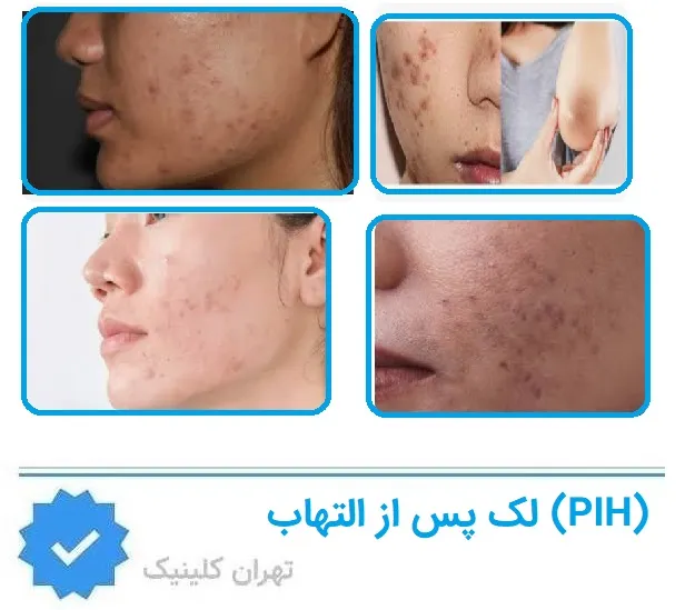 لک پس از التهاب (PIH)
